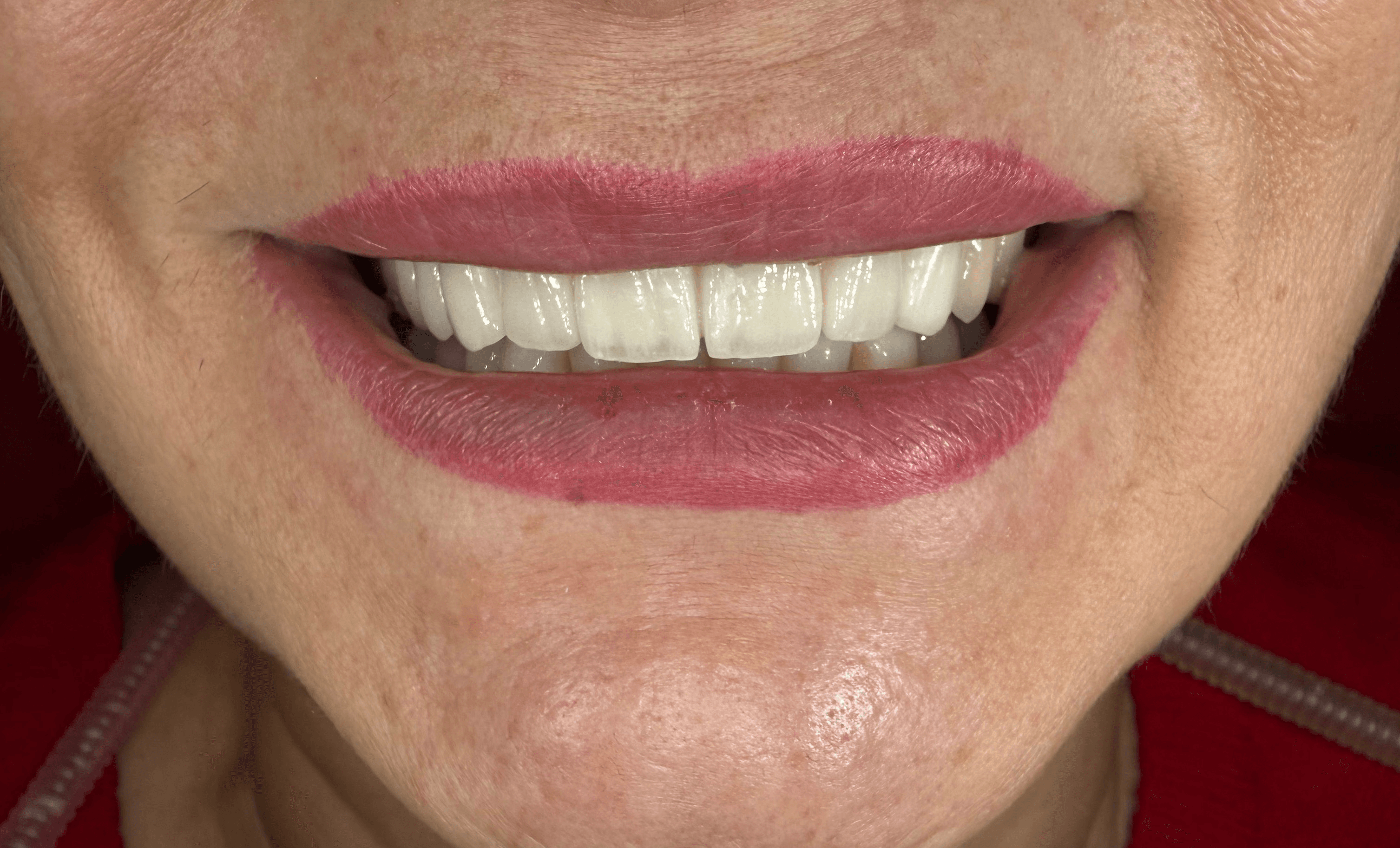 Full mouth: Coroane, punți și coroane pe implant, din zirconiu stratificat